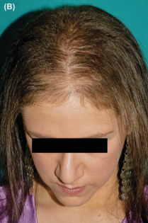 Alopecia After 1 Treatment